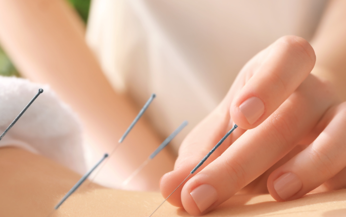 How to become an acupuncturist