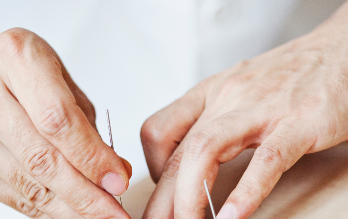 Acupuncture needles on the lower back