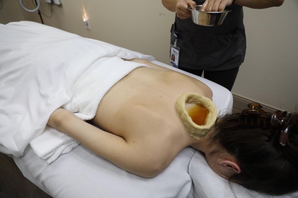 A photo of an unidentifiable patient receiving a Greeva Basti (neck therapy) Ayurveda treatment at SCU Health.